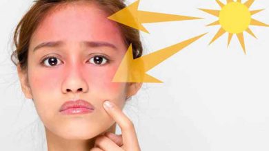 پوست آفتاب سوخته